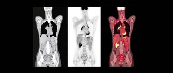 PET-CT 사진1