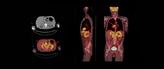 PET-CT 사진2