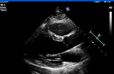 심장초음파 사진1