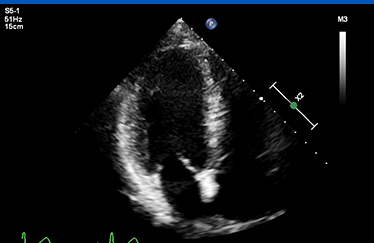 심장초음파 사진2