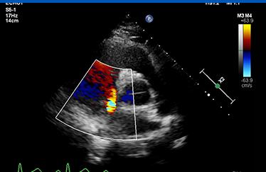 심장초음파 사진3