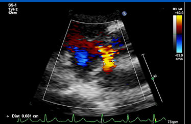 심장초음파 사진4