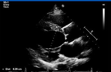 심장초음파 사진5