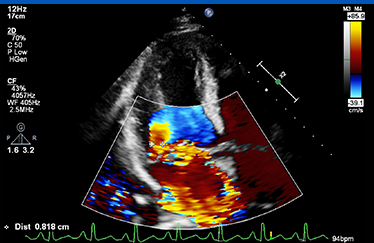 심장초음파 사진7