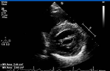심장초음파 사진8