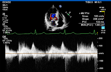 심장초음파 사진9