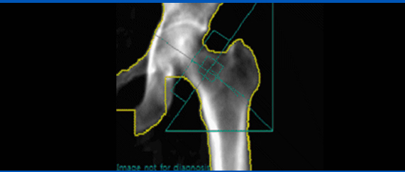 골밀도 사진2