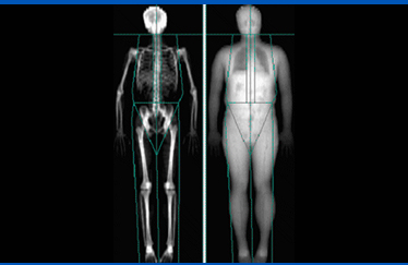 골밀도 사진3